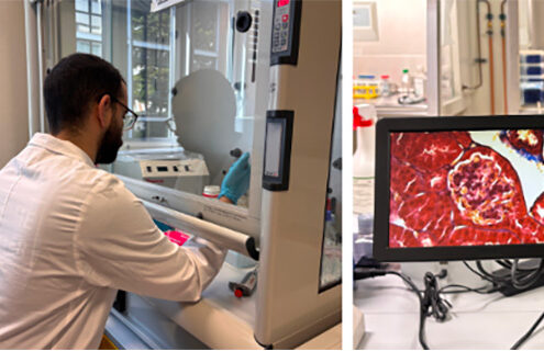 Fibrosi e diabete tipo 1: una complicanza silenziosa da conoscere meglio