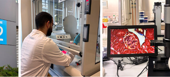 Fibrosi e diabete tipo 1: una complicanza silenziosa da conoscere meglio